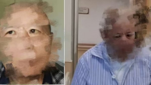 老钱庄 大爷脑梗后遗留罕见斜视问题，无法“正眼看人”，上海医生：这病能治！